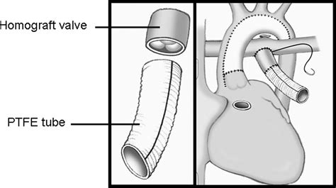 lv to pa conduit|pulmonary homograft conduit performance.